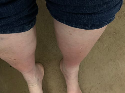 Customer photo review of Everstride™ Advanced Wide Compression Socks For Pain Relief