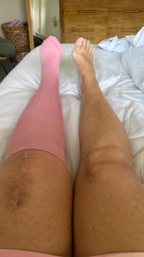 Customer's legs in bed, one with a pink Everstride Compression Sock and one without, showing post-surgery use.